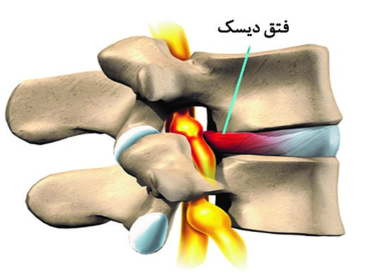 ديسك ستون فقرات